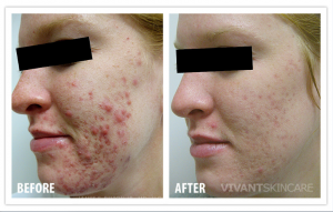 acne vivant bna