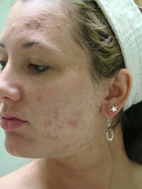 Acne Treatment Before After 