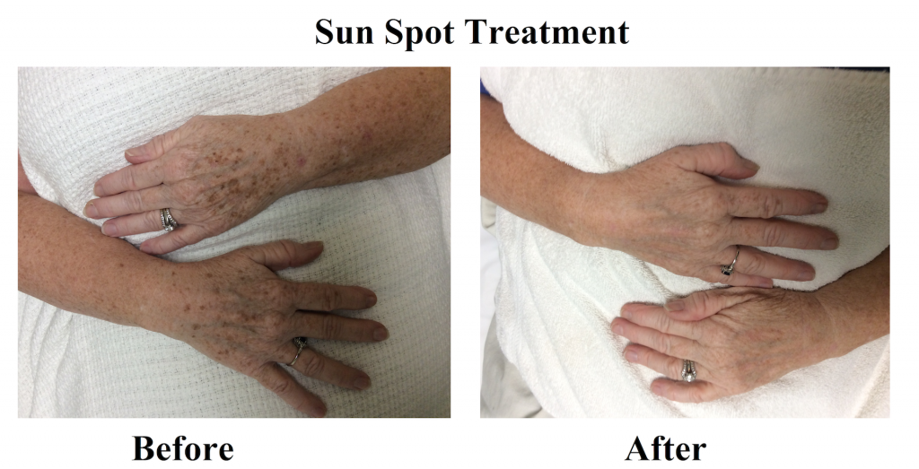 Sun Spot Treatment Before and After