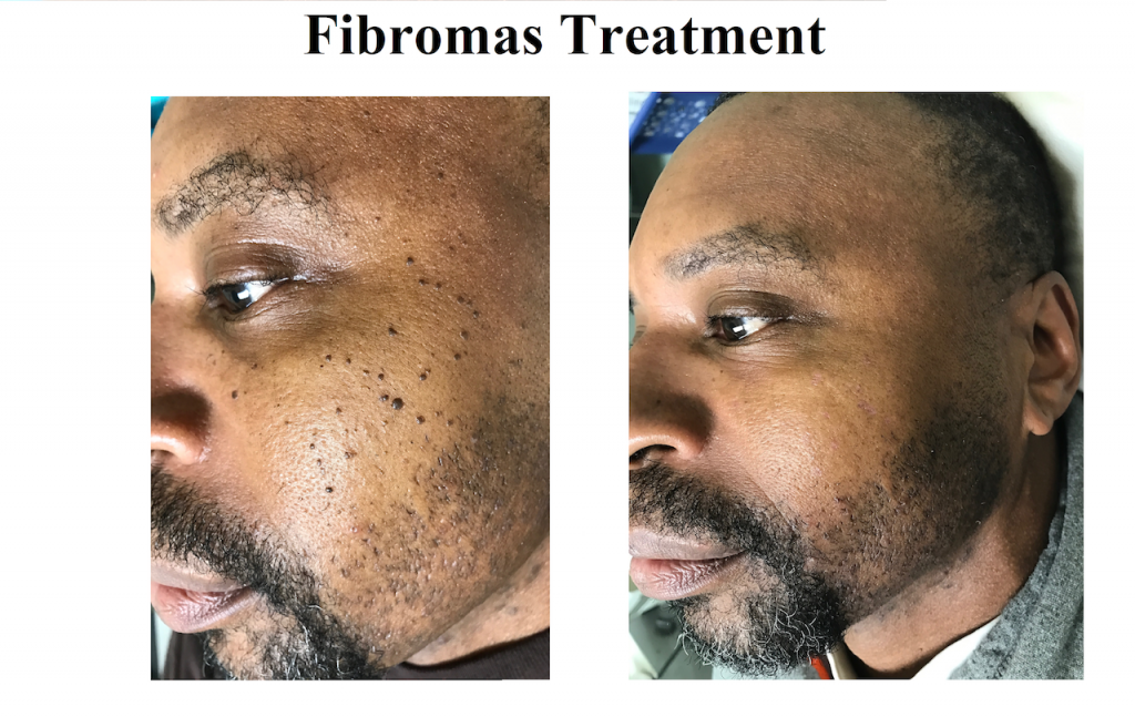 Fibromas Before After