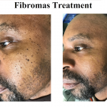 Fibromas Before After