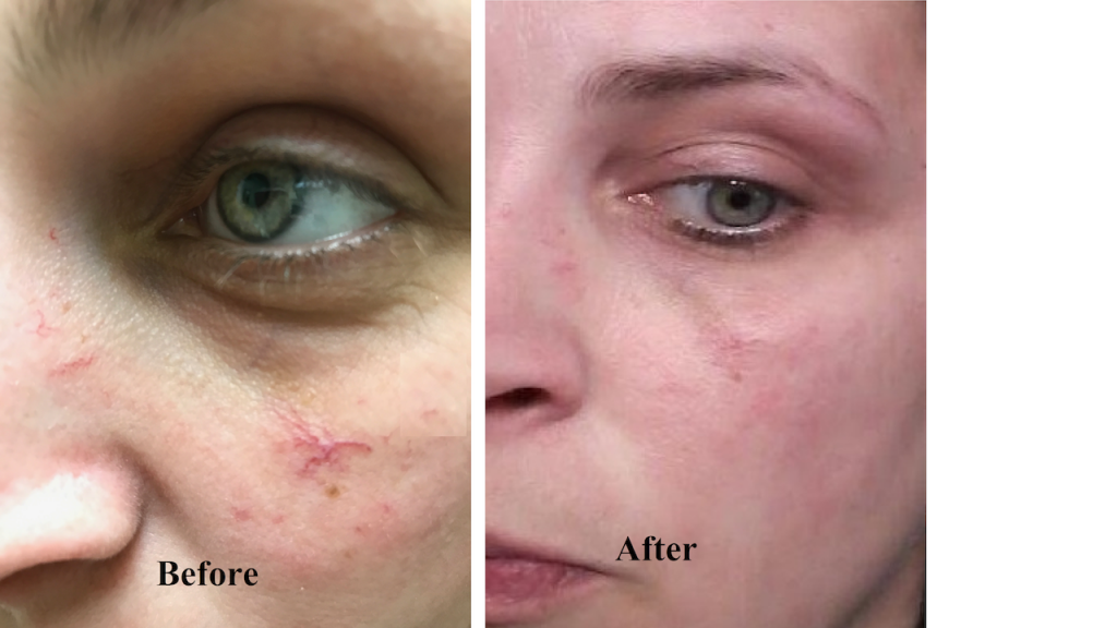 Telangiectasia (broken capillary) Before and After