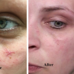 Telangiectasia (broken capillary) Before and After