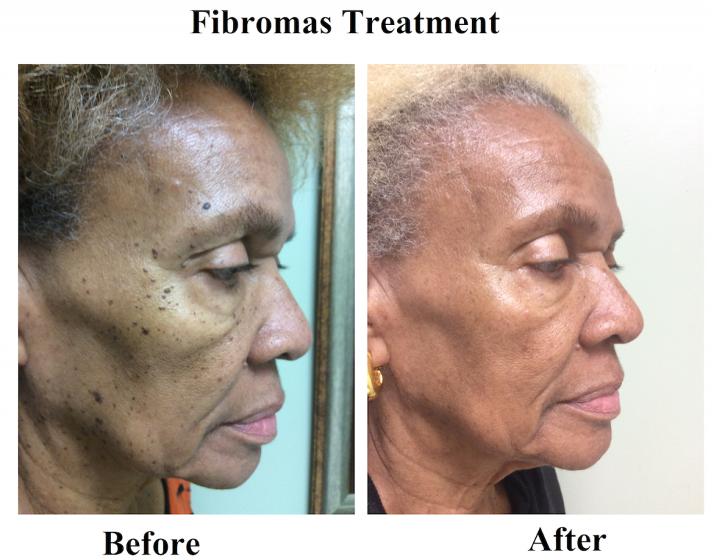 Fibromas Before After