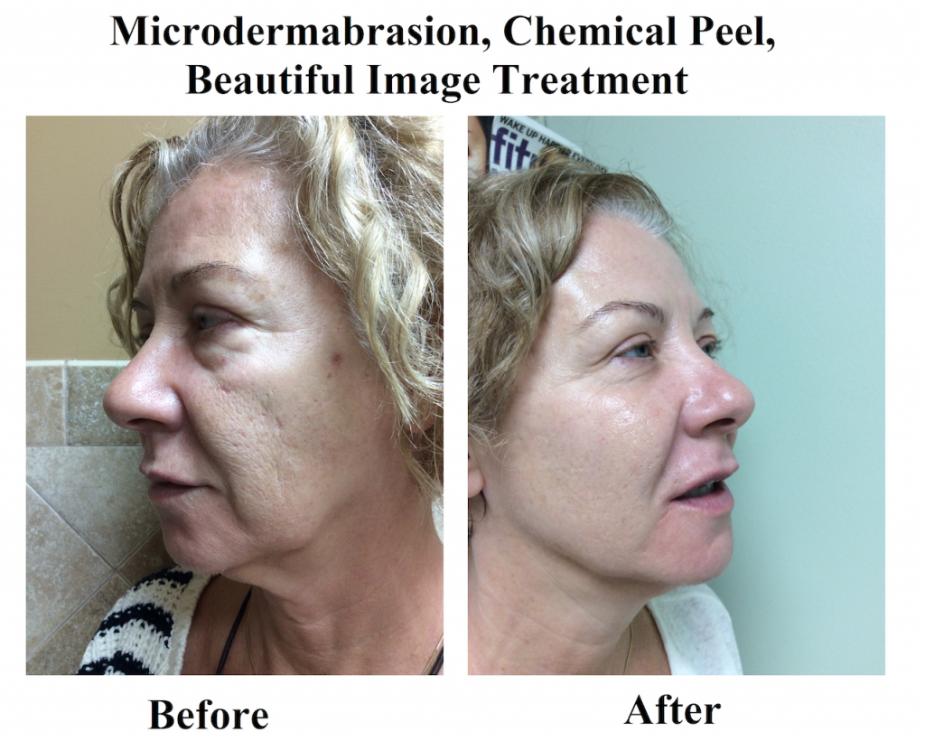 Microdermabrasion, Chemical Peel, Beautiful Image Treatment Before and After