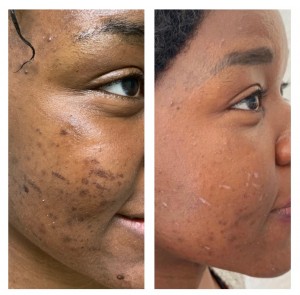 ACNE TREATMENT BEFORE & AFTER