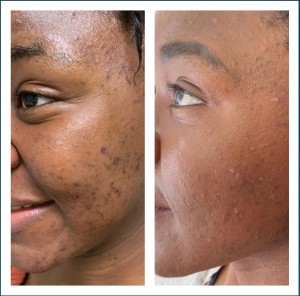 ACNE TREATMENT BEFORE & AFTER