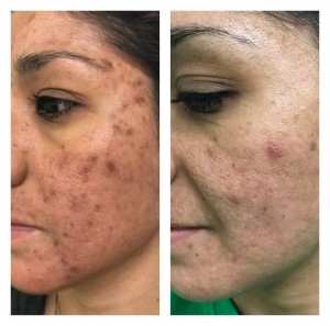 ACNE TREATMENT BEFORE & AFTER