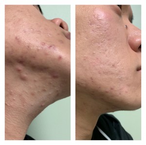 ACNE TREATMENT BEFORE & AFTER