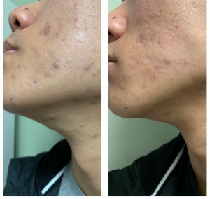 ACNE TREATMENT BEFORE & AFTER