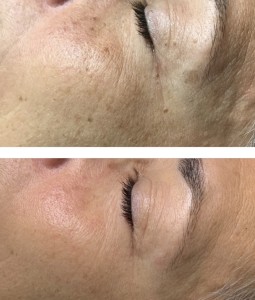 ANTI-AGING TREATMENT BEFORE & AFTER