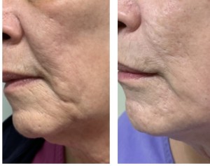 ANTI-AGING TREATMENT BEFORE & AFTER