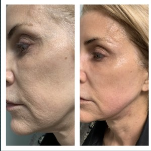 ANTI-AGING TREATMENT BEFORE & AFTER