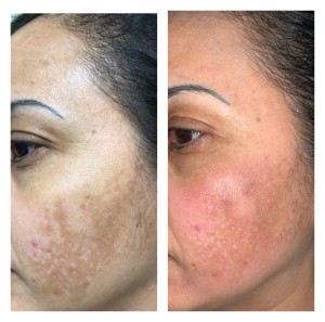 HYPER-PIGMENTATION TREATMENT BEFORE & AFTER