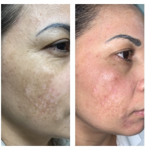 HYPER-PIGMENTATION TREATMENT BEFORE & AFTER