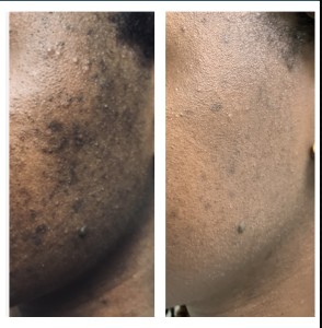 ACNE HYPERPIGMENTATION BEFORE & AFTER