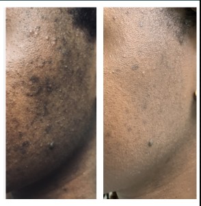 ACNE TREATMENT BEFORE & AFTER