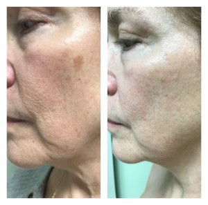 ANTI-AGING TREATMENT BEFORE & AFTER