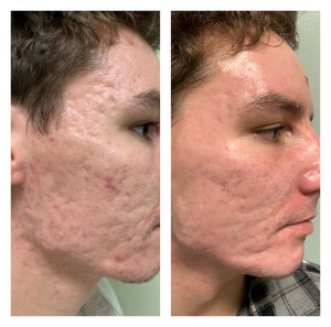 ACNE TREATMENT BEFORE & AFTER