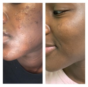 ACNE TREATMENT BEFORE & AFTER