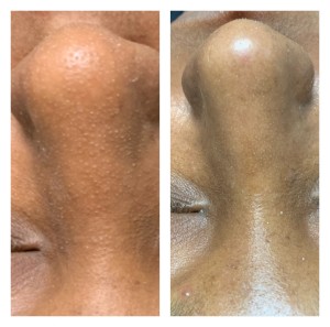 NOSE TREATMENT BEFORE & AFTER