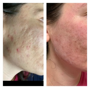 ACNE TREATMENT BEFORE & AFTER