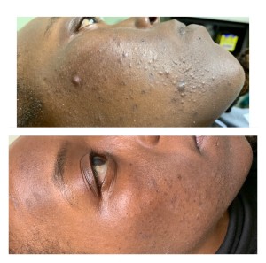 ACNE TREATMENT BEFORE & AFTER